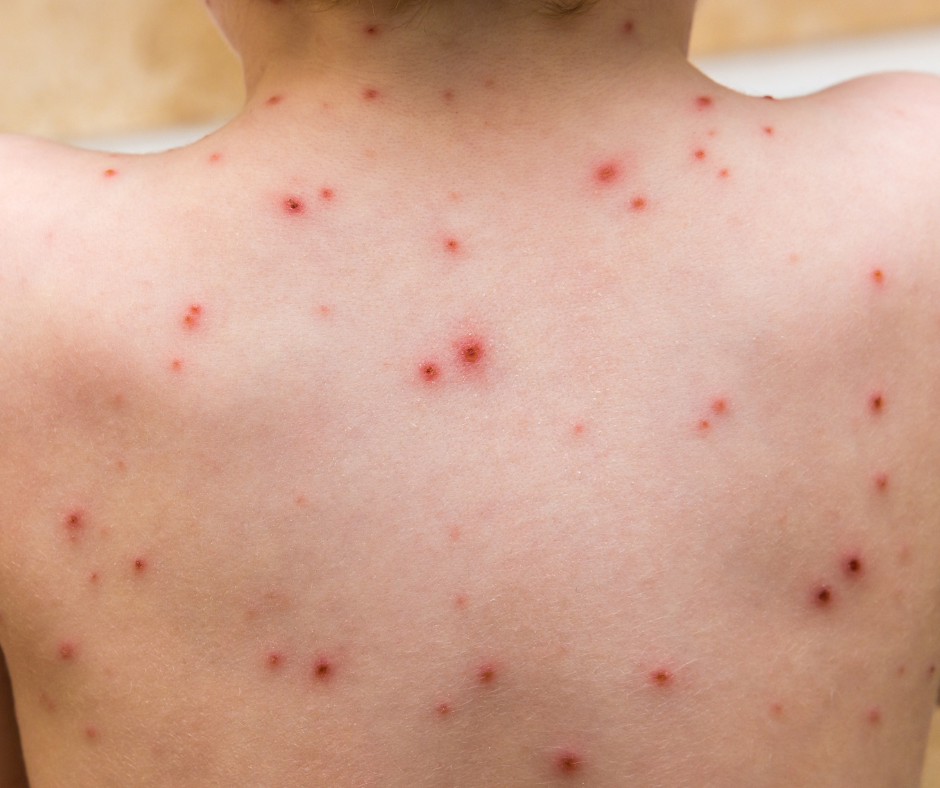 Chicken Pox Vaccine Safe And Effective HIQA Highland Radio Latest 